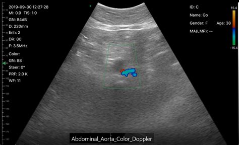 Abdominal Aorta Color Doppler Edge Life Technologies The Leading Innovators In Ultrasound