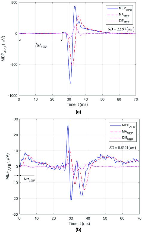 Estimation Of Mep Latency Using The Sm Algorithm For A Mep Signal