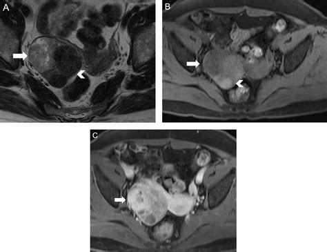 Magnetic Resonance Imaging In Tubal And Non Tubal Ectopic Pregnancy