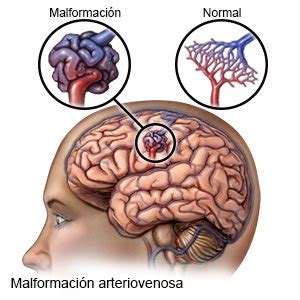 Malformaciones Arteriovenosas Angioteam