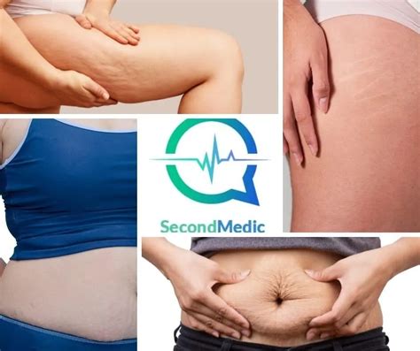 Stretch Marks Causes And Treatment SecondMedic