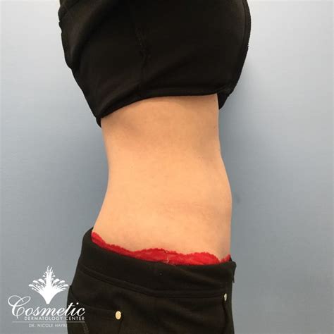 Emsculpt Muscle Toning And Fat Reduction Treatments In Mclean Va