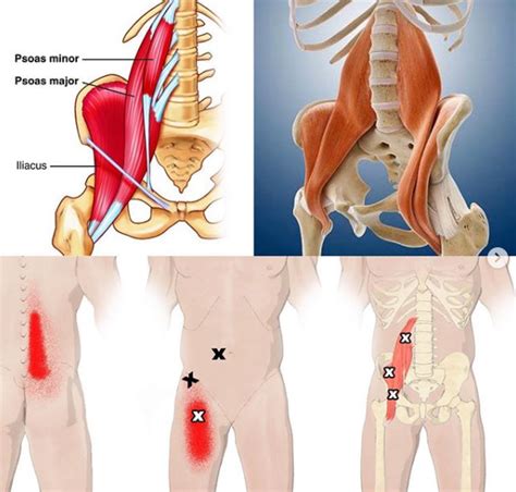 Slijmbeursontsteking Aan De Heup Bursitis Trochanteria Artofit