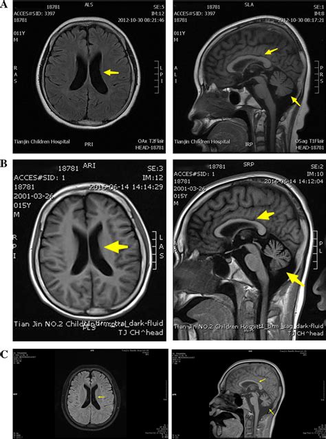 Brain MRI findings. the brain MRI showed mild enlargement of lateral ...