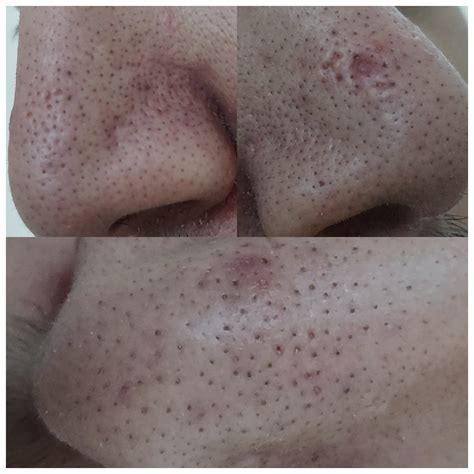 Retin A Before And After Blackheads