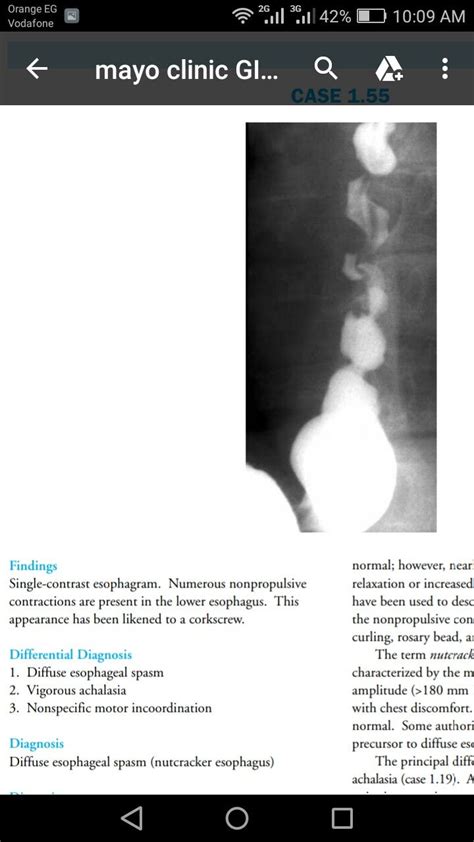 Corkscrew Esophagus Is Seen in Which of the Following Conditions