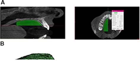 Evaluation Of Maxillary Arch Width And Palatal Volume And Depth In