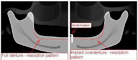 A case for Fixed hybrid prosthesis vs. the removable overdenture