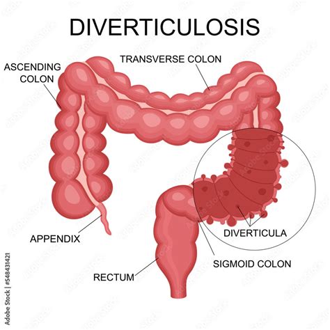 Vecteur Stock Diverticulosis Vector Illustration Medical Structure And Location Diverticula