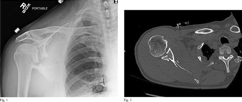 Figure From Arthroscopically Assisted Reduction And Internal Fixation