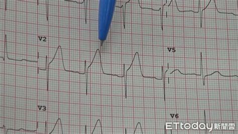 心電圖有異！台東翁心肌梗塞「正在發生」 1小時植2支架救一命 Ettoday健康雲 Ettoday新聞雲