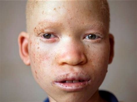 Tanzania's Albinos Hope Govt Will Offer More Help