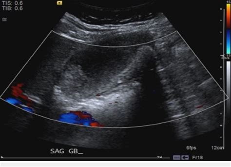 Right Upper Quadrant Ultrasound