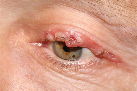 Eyelid Cyst Lower