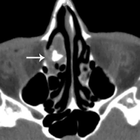 Chronic Invasive Fungal Rhinosinusitis Computed Tomography Ct Scan