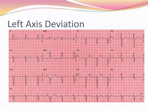 12 Lead Ekg Interpretation Ppt