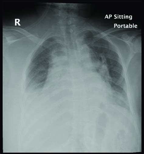 Anteroposterior Semisitting Portable Chest Radiograph Immediately After