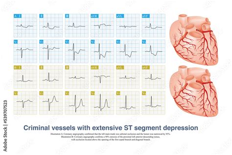 case  acute coronary syndrome   ecg shows extensive st