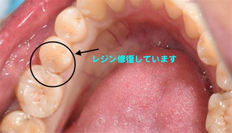 歯の中で広がっている虫歯 小嶋デンタルクリニック