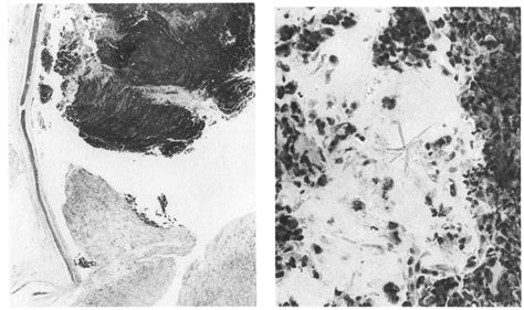 Left Tissue From The Sinus Specimen In Case No 2 Shows A Large