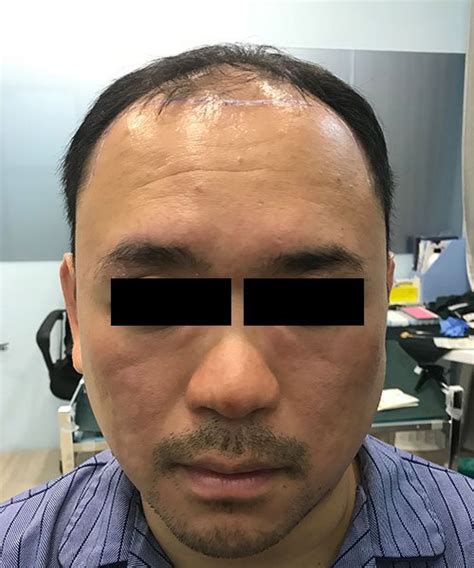 Fue Hair Transplant Kuala Lumpur Malaysia Fue Hair Transplant Price