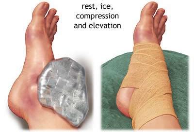 Foot and Ankle Conditions | Ankle Sprain Rehabilitation Exercises