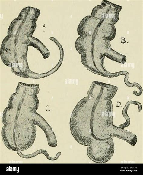 Intussusception Types