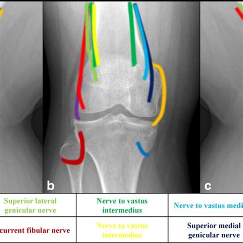 The Effectiveness And Safety Of Genicular Nerve Radiofrequency Ablation For The Treatment Of