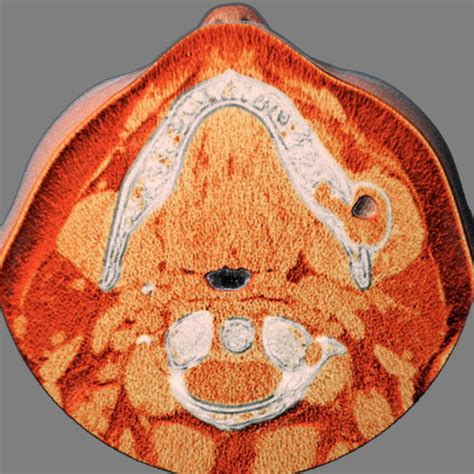 reconstructed cut showing  liquid content   cystic lesion
