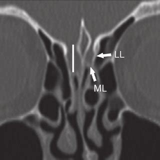 (a) Coronal CT scan showing bilateral concha bullosa of the middle ...