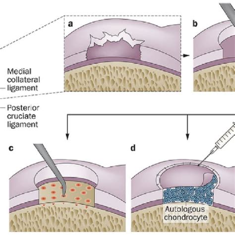 Tissue Engineering Strategies For Articular Cartilage Regeneration