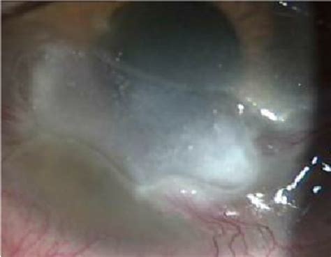 Corneal Neurotrophic Ulcers After Medical Treatment Patient Who Was