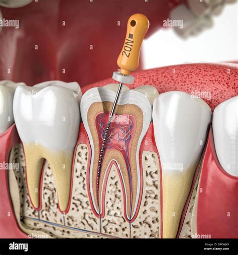 Sección Transversal Del Diente Humano Con Lima Rotatoria Endodóntica