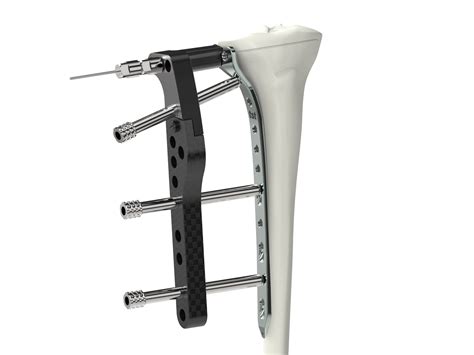 Miss Proximal Tibia Lateral Plates Tst