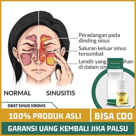 Jual Obat Sinusitis Inflamasi Atau Peradangan Kronis Pada Dinding Sinus