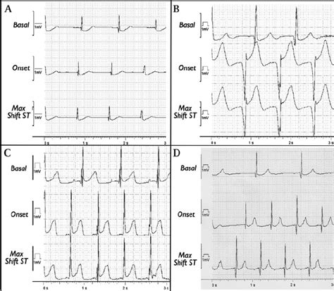 Stored Intracardiac Electrograms From Four Case Subjects Showing