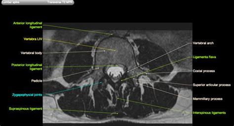 Lumbar spine anatomy on MRI (Magnetic Resonance Imaging) | Anatomy ...