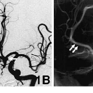 Three Dimensional Computed Tomography Angiogram A Showing An Azygos