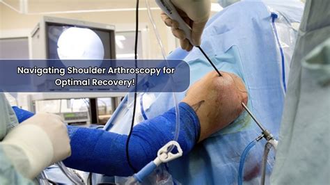 Shoulder Arthroscopy: Elevating Movement, Redefining Freedom - Wellness ...