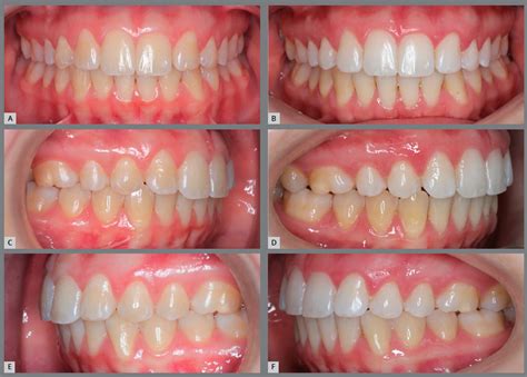 Scielo Brazil Agenesis Of Maxillary Lateral Incisors Diagnosis And