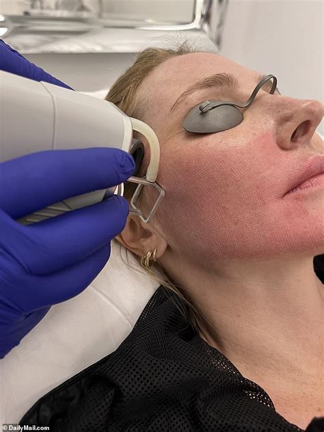 Nikki Lund Gets 14k Non Surgical Face Lift From Kim Kardashians