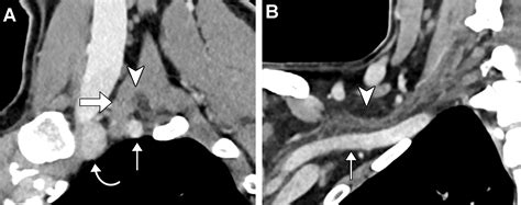 Subclavian Artery Anatomic Review And Imaging Evaluation Of Abnormalities Radiographics