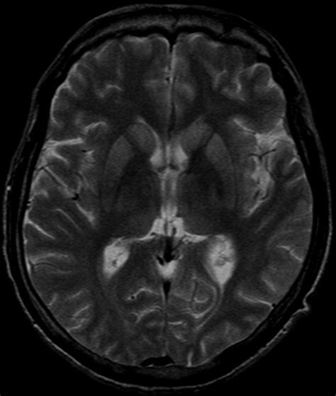 Creutzfeldt-Jakob Disease (Or Kuru) at Aileen Markham blog