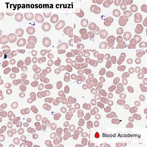 Trypanosoma cruzi - Blood Academy