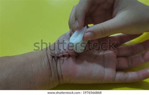 Close Cleaned Stitches Wound On Hand Stock Photo 1976566868 | Shutterstock