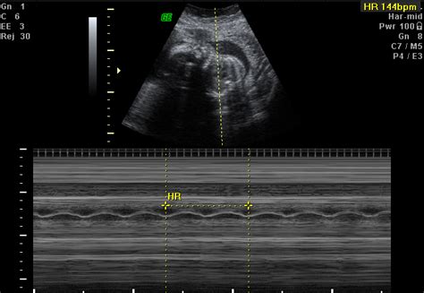 Ultrasound - Pelvic | imagingandultrasound