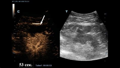 Ultrasound Journal 12 - Multiparametric Ultrasound in Differentiating a Complex Cystic Renal ...