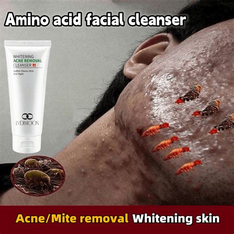 Acne face wash Amino acid facial cleanser 氨基酸洗面奶100g Remove Acne Acne