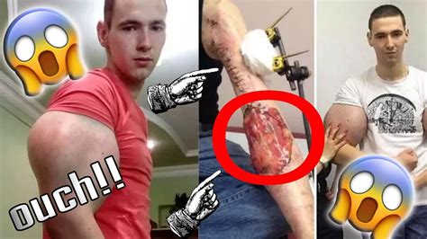 Synthol Kid Nearly Loses His Arms Synthol Kid Russian