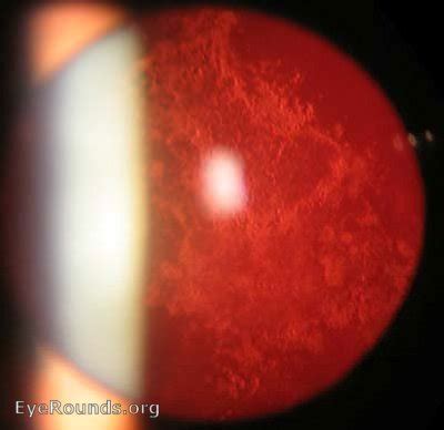 Atlas Entry - Posterior capsular opacity (PCO) following cataract surgery